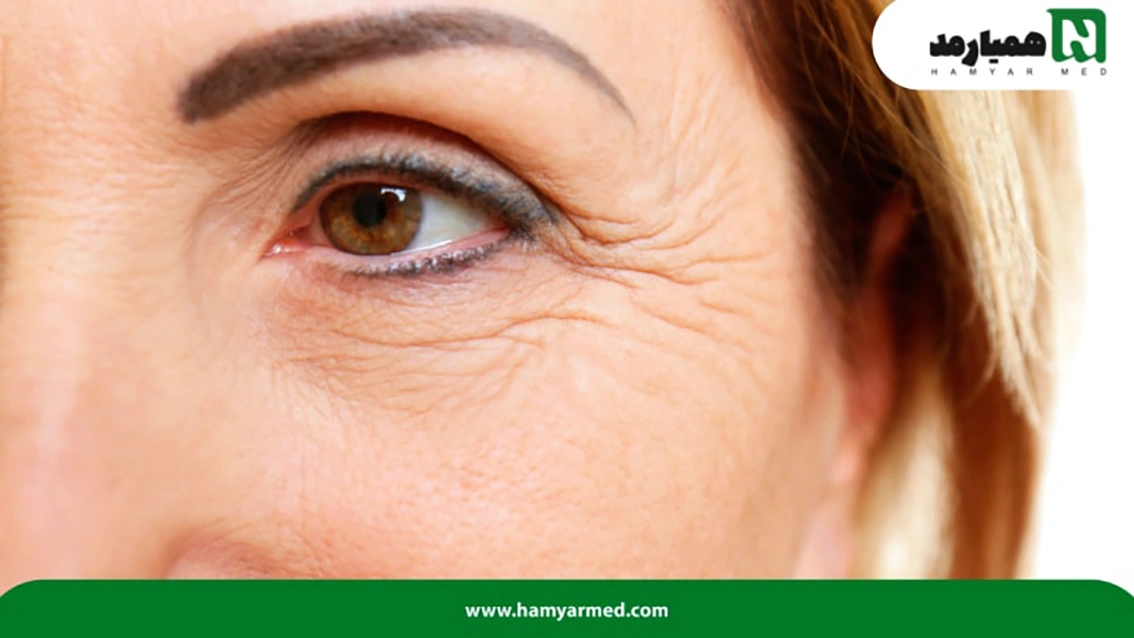 پوست-دهیدراته-که-دچار-چین-و-چروک-شده