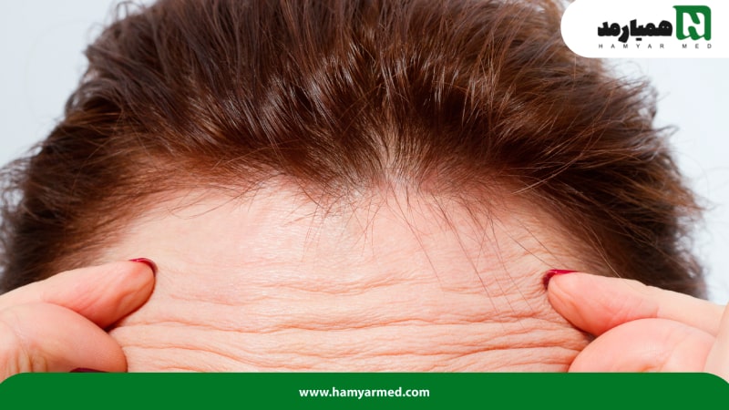 چین و چروک‌های نسبتا عمیق روی پیشانی یک فرد