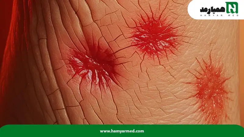 تاثیر دیابت بر پوست با لکه های قرمز و پاسخ به سوال دیابت چیست